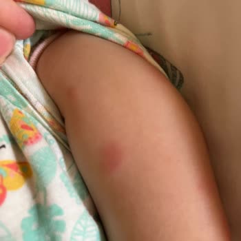 Möller's Balık Yağı Alerji Yaptı
