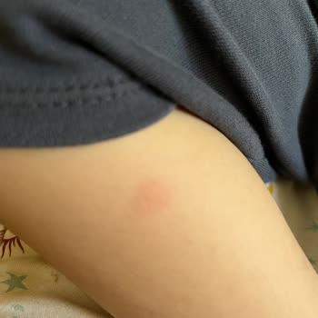 Möller's Balık Yağı Alerji Yaptı