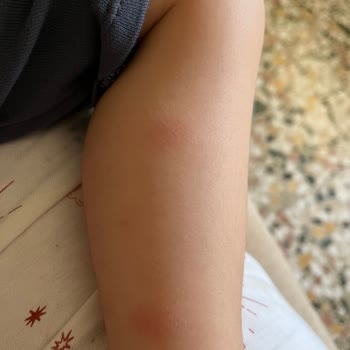 Möller's Balık Yağı Alerji Yaptı