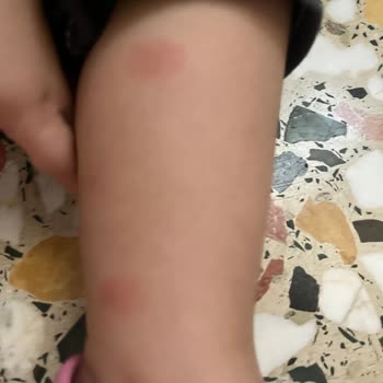 Möller's Balık Yağı Alerji Yaptı