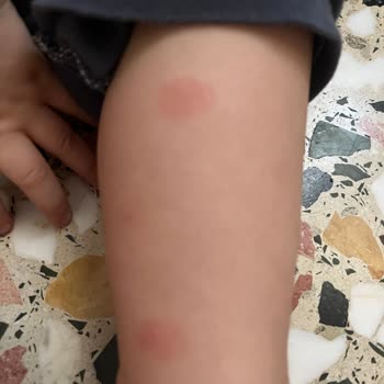 Möller's Balık Yağı Alerji Yaptı