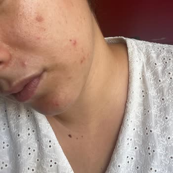 The Purest Solutions Ürün Kullanımı Sonrası Cilt Problemleri Yaşadım