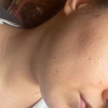 The Purest Solutions Ürün Kullanımı Sonrası Cilt Problemleri Yaşadım