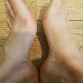 Birkenstock Terlikler Ayak Tarak Kısımlarında Nasır Ve Tahriş Sorunu