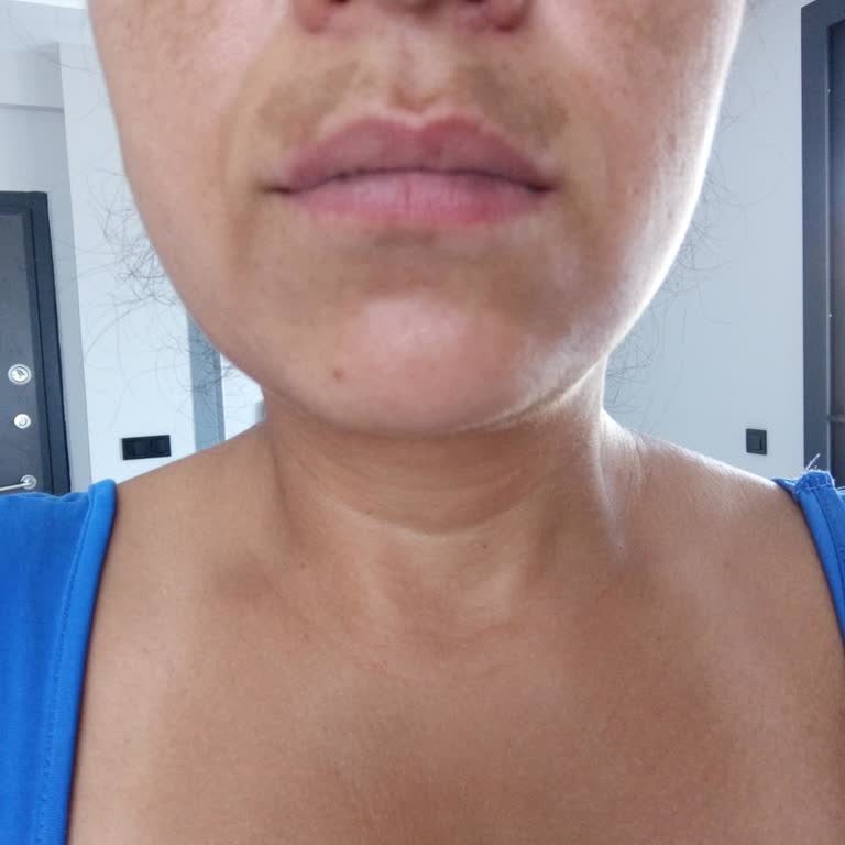 Özel Dermaclinic Poliklinik Leke Tedavisinde Beklentilerimi Karşılamadı