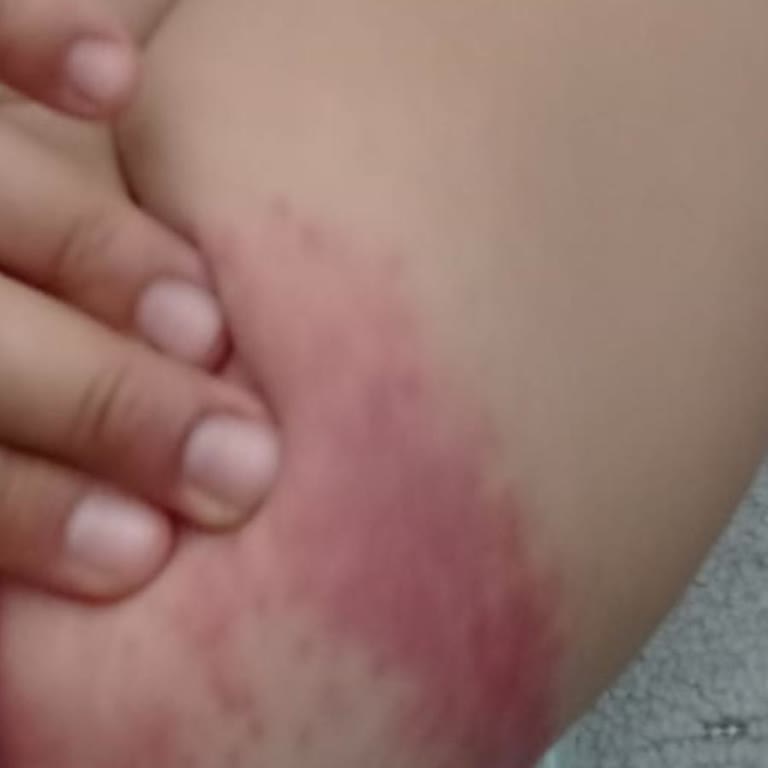 Mustela Bebeğimde Pişik Kremi Kullanımı Sonrası Cilt Sorunları