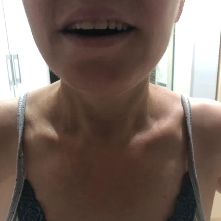 Estrella Medical Group Gençlik Aşısı Sonrası Mimik Kaybı Ve Para İadesi Sorunu