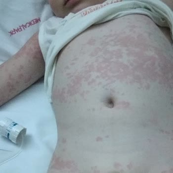 Ozmo Çikolataları Alerji Yapıyor!