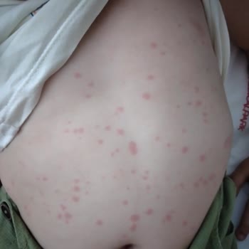 Ozmo Çikolataları Alerji Yapıyor!