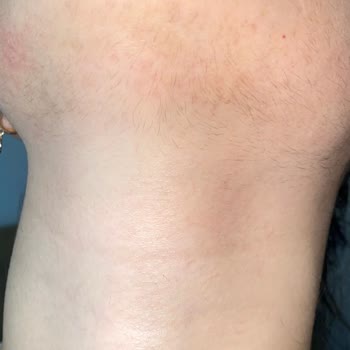 buzlazer.com Buzlazer İle Yüzümde Ve Vücudumda Eskisinden Daha Çok Tüy Çıktı.