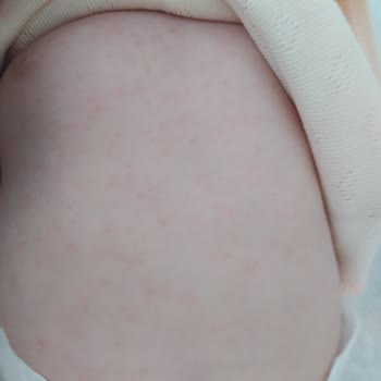 Sma Optipro Alerji Yaptı