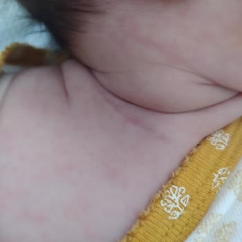 Sma Optipro Alerji Yaptı