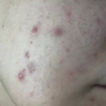 Yves Rocher Sebo Pure Vegetal Serisi Yüzümü Mahvetti