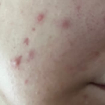 Yves Rocher Sebo Pure Vegetal Serisi Yüzümü Mahvetti