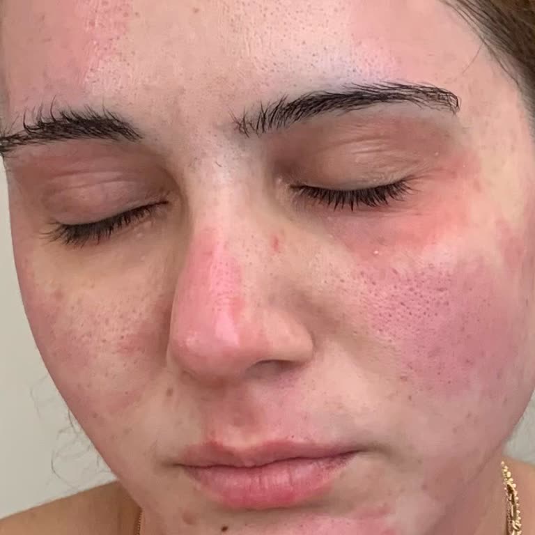 Abdi İbrahim Hametan Yüzde Yanma Ve Kızarıklık Yapıyor!