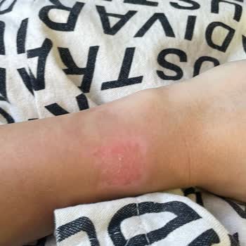 Apple Watch Se Sıcaktan Kolumu Yaktı