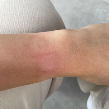 Apple Watch Se Sıcaktan Kolumu Yaktı