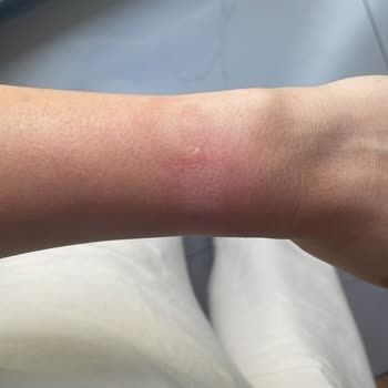 Apple Watch Se Sıcaktan Kolumu Yaktı