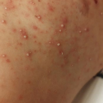 Cire Aseptine Güneş Kremi Hastanelik Etti