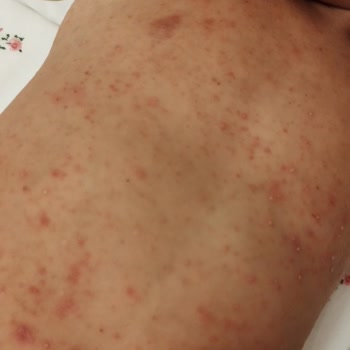 Cire Aseptine Güneş Kremi Hastanelik Etti