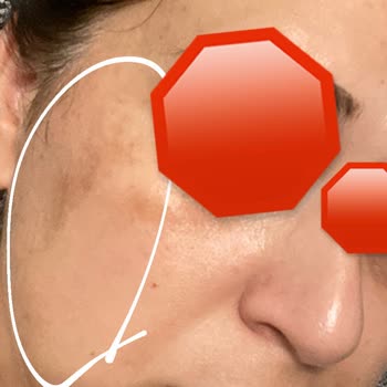 Yves Rocher Krem Ve Serum Yüzümde Leke Ve Yanık Yaptı