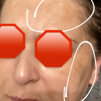 Yves Rocher Krem Ve Serum Yüzümde Leke Ve Yanık Yaptı