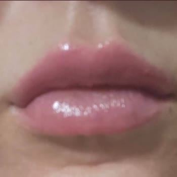 Filiz Akın Estetik Bayraklı İzmir Dolgu Mağduru!