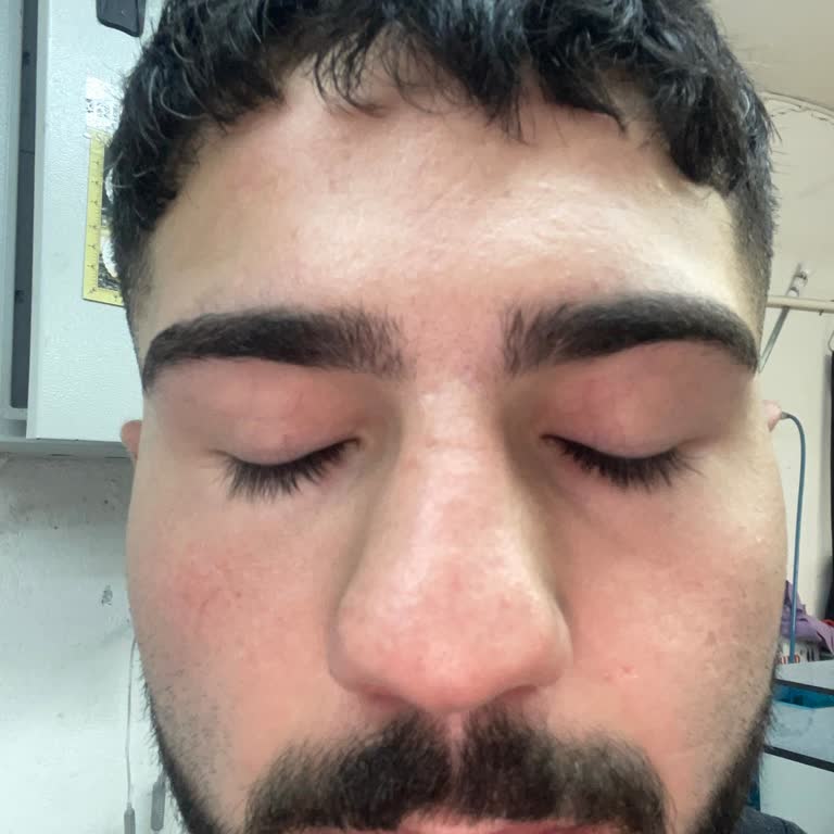 Sultanbeyli Devlet Hastanesi Burun Büyüklüğü Ameliyat