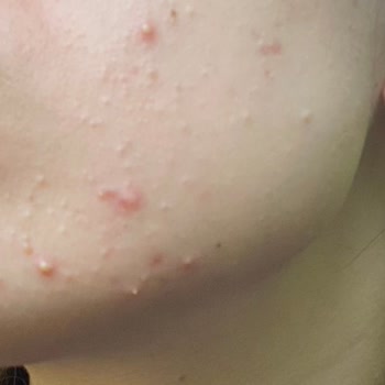 The Purest Solutions The Purest Cildimde Sivilce Çıkardı