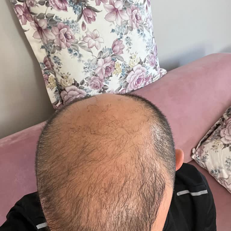 Emphair Saç Ekim Merkezi Yüksek Ücretli Hizmette Hayal Kırıklığı Ve Saç Dökülmesi Sorunu