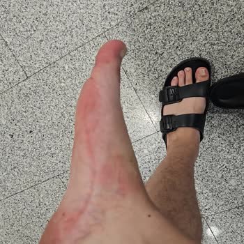 Birkenstock Sorunlu Terlik Marka Arkasında Durmadı