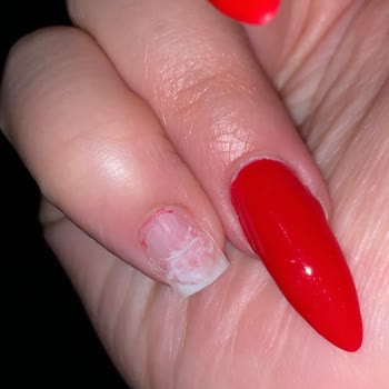 Hazal Akbay Beauty'de Protez Yaptırdım, Mağdur Oldum!