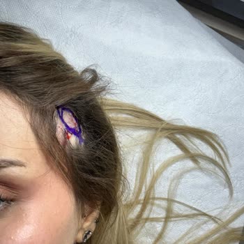 Estethica Ameliyat Sonrası Saçımı Mahvettiler