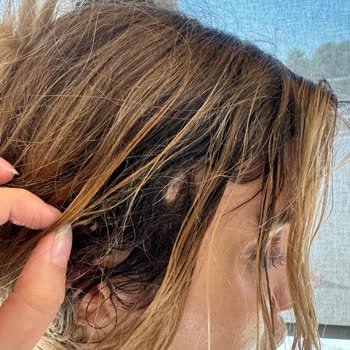 Estethica Ameliyat Sonrası Saçımı Mahvettiler