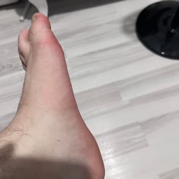 Trendyol Ayağımı Yara Yapan Terliği Geri Yollaması.