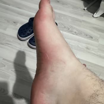 Trendyol Ayağımı Yara Yapan Terliği Geri Yollaması.