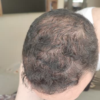 Bioxcin İn Saç Dökülmesini Arttırdığı Saçsız Bıraktığı