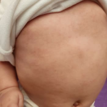 Mustela Krem Alerji Yaptı