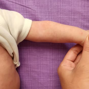 Mustela Krem Alerji Yaptı