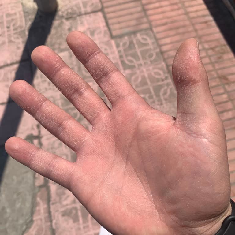 Batiste Türkiye Kuru Şampuan Kullanımı Sonrası Dermatolojik Sorunlar