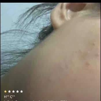 La Roche - Posay Yanlış Ürün Ve Cilt Sorunlarıyla Mağduriyet