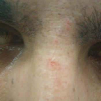 Naomi Güzellik Merkezi Lazerle Yüz Yakması