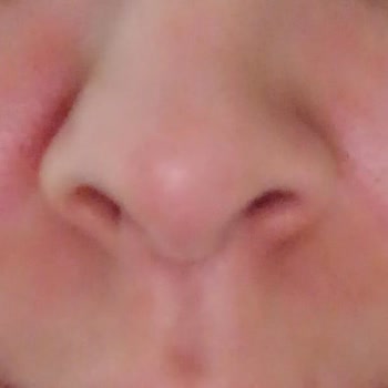 Adverse Reaction to Bepanthol Derma Moisturizer with SPF 25