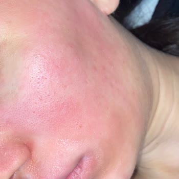 Severe Reaction to Bepanthol Cream for Very Dry and Atopic Skin