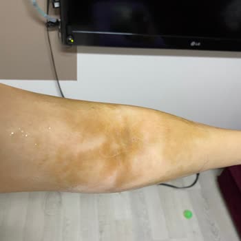 Özel Ümit Hastanesi Hemşire İhmali Ve Sorumsuzluğu