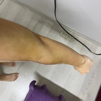 Özel Ümit Hastanesi Hemşire İhmali Ve Sorumsuzluğu