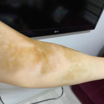 Özel Ümit Hastanesi Hemşire İhmali Ve Sorumsuzluğu