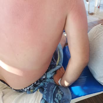 Bioxcin Yanlış Kullanım Tavsiyesi İle Tatilimiz Mahvoldu