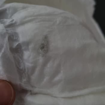 Sleepy Bebek Bezinin İçinde Çıkan Yabancı Madde