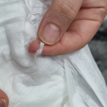 Sleepy Bebek Bezinin İçinde Çıkan Yabancı Madde